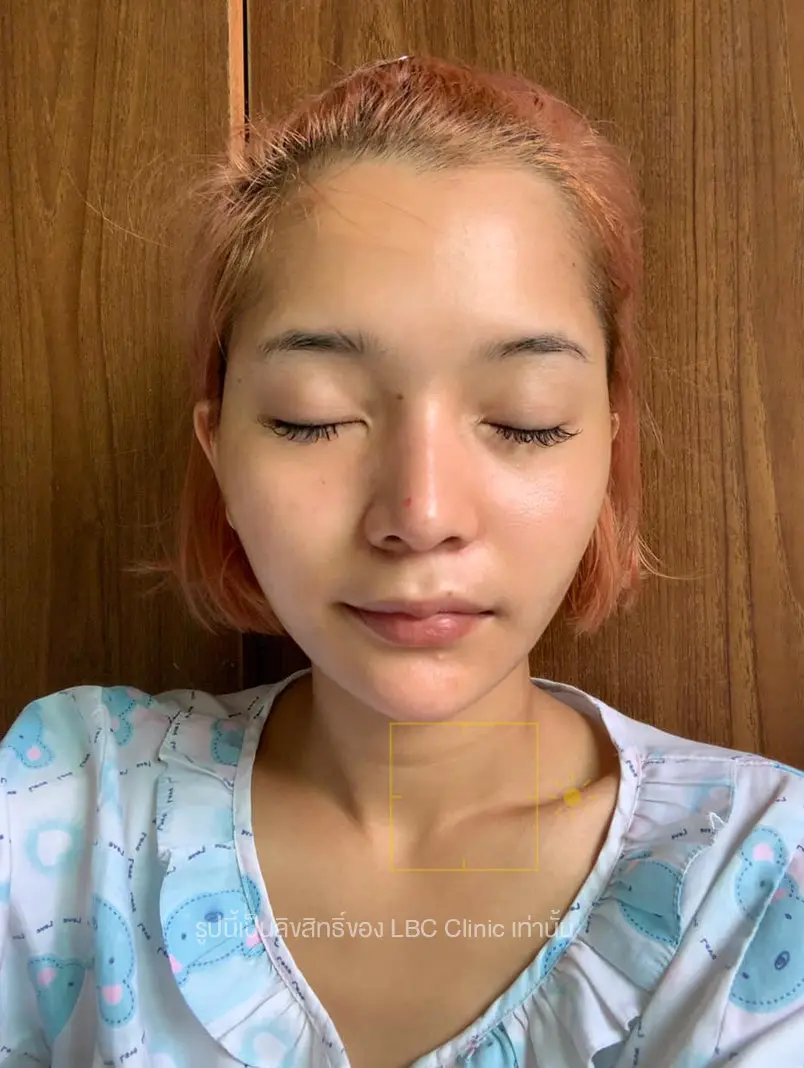 หลังร้อยไหม